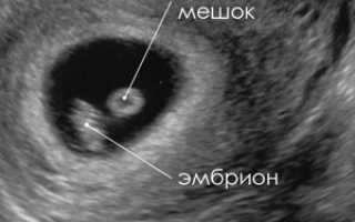 УЗИ на 5-6 неделе беременности