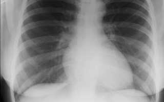 Рентгенография сердца