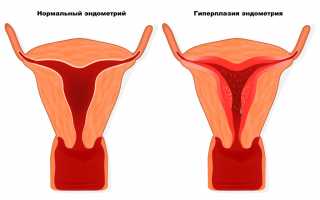 Характеристика заболевания и как лечится гиперплазия эндометрия матки в менопаузе?