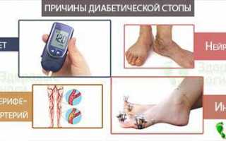 Синдром диабетической стопы лечение