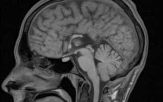 Дисгенезия мозолистого тела