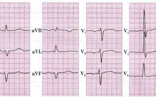 Изменения на ЭКГ при сердечных блокадах