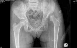 Дисплазия тазобедренных суставов на рентгене