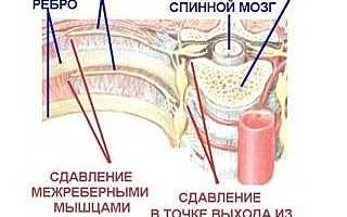 Всё о невралгии грудной клетки (грудного отдела)