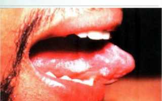 Симптомы вируса ВИЧ в полости рта