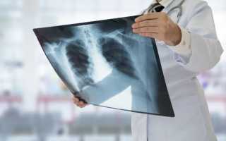 Насколько вреден рентген и чем он опасен?