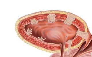 Симптомы и лечение рака мочевого пузыря