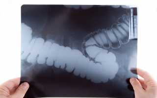 Рентгенография кишечника с барием: что показывает и как делается?