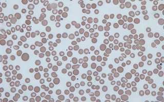 Что означает анизоцитоз в анализе крови