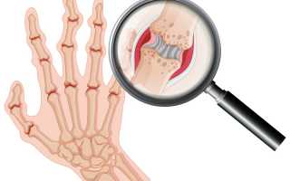 Ревматоидный артрит: особенности диагностики