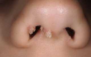 Папиллома на носу, в ноздрях: виды, причины, лечение