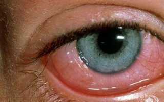 Причины, симптомы и помощь при отечности глазного яблока