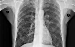 Рентген грудной клетки: показания, техника проведения и результаты