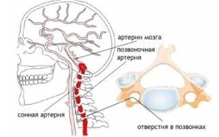 Признаки, лечение и последствия гипоплазии позвоночной артерии