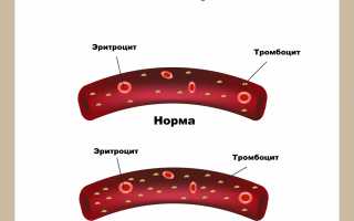 Что означает повышение среднего объема тромбоцитов в крови