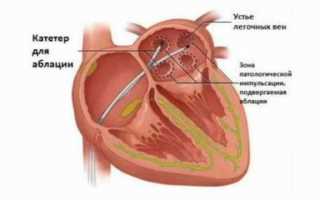 Учащенное сердцебиение при нормальном давлении причины лечение