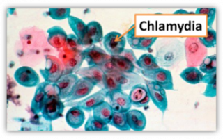 Хламидия трахоматис: что это такое и ее виды, источник заражения, опасность, симптомы