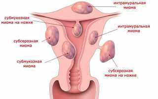 Основные симптомы и признаки развития миомы матки при климаксе