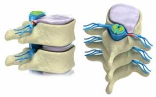 Народные методы лечения позвоночной грыжи