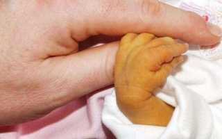 Гемолитическая болезнь новорожденных последствия в будущем