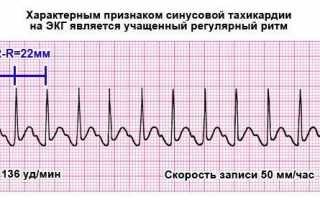 Абляция в кардиологии