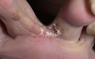 Симптомы и лечение грибка между пальцами ног