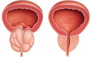 Как лечить простатит в молодом возрасте