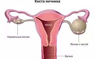 Причины и лечение кистозных изменений на яичниках