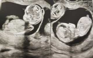 Пренатальные скрининги при многоплодной беременности