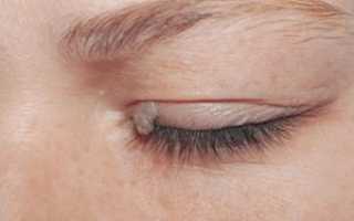 Инвертированная папиллома полости носа: характеристики, симптомы, диагностика