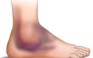 Причины и методы лечения отечности голеностопного сустава