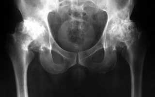 Остеопороз: рентгенологические признаки