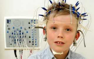 ЭЭГ при эпилепсии: что вы должны знать