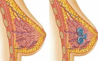 По какой причине при климаксе могут болеть молочные железы?