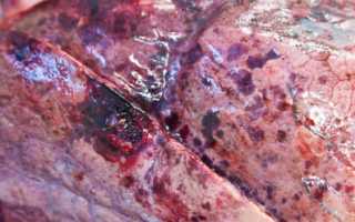 Признаки кровотечения из варикозно расширенных вен пищевода