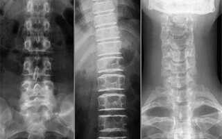 Рентген грыжи позвоночника: как выглядит грыжа, как делают рентген грыжи