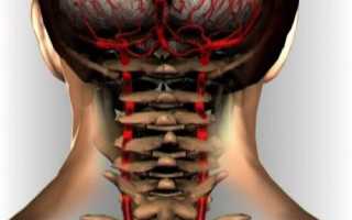 Артериальное давление при шейном остеохондрозе