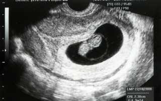 Как делают УЗИ на сроке 6 акушерских недель беременности, каковы нормы диагностики?