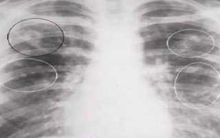 Видно ли туберкулез на снимке рентгена?