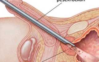 Как проводится лечение простатита лазером?