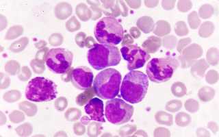 Повышенное количество моноцитов в крови женщины