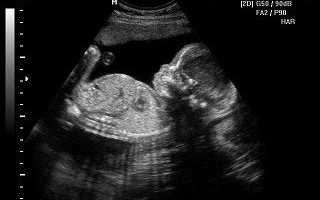 УЗИ на 11-12 неделе беременности: особенности скрининга