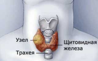 Цистаденома щитовидки, симптомы, диагностика и методы лечения