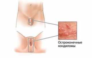 Папилломы на теле и на коже: причины, симптомы, виды образований