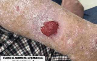 Симптомы и лечение плоскоклеточного рака кожи