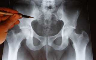 Рентген копчика: особенности проведения диагностики