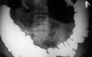 Рентгенография брюшной полости