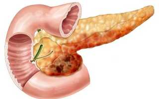 Как развивается острый деструктивный панкреатит?