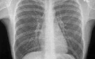 Как выглядит рентгеновский снимок легких в норме и при патологиях