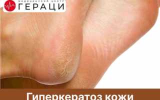 Истинный гиперкератоз кожи: лечение